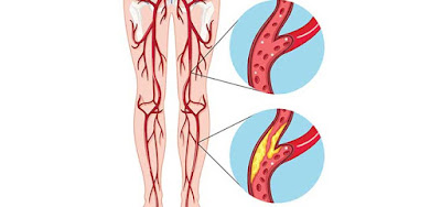 best vascular surgeon in Delhi NCR best vascular surgeon in Delhi NCR - Aakash Healthcare