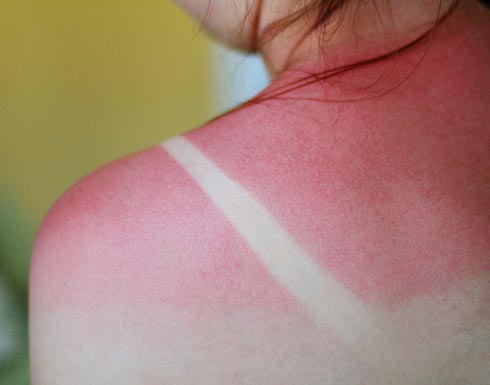 طرق التخلص من حروق الشمس