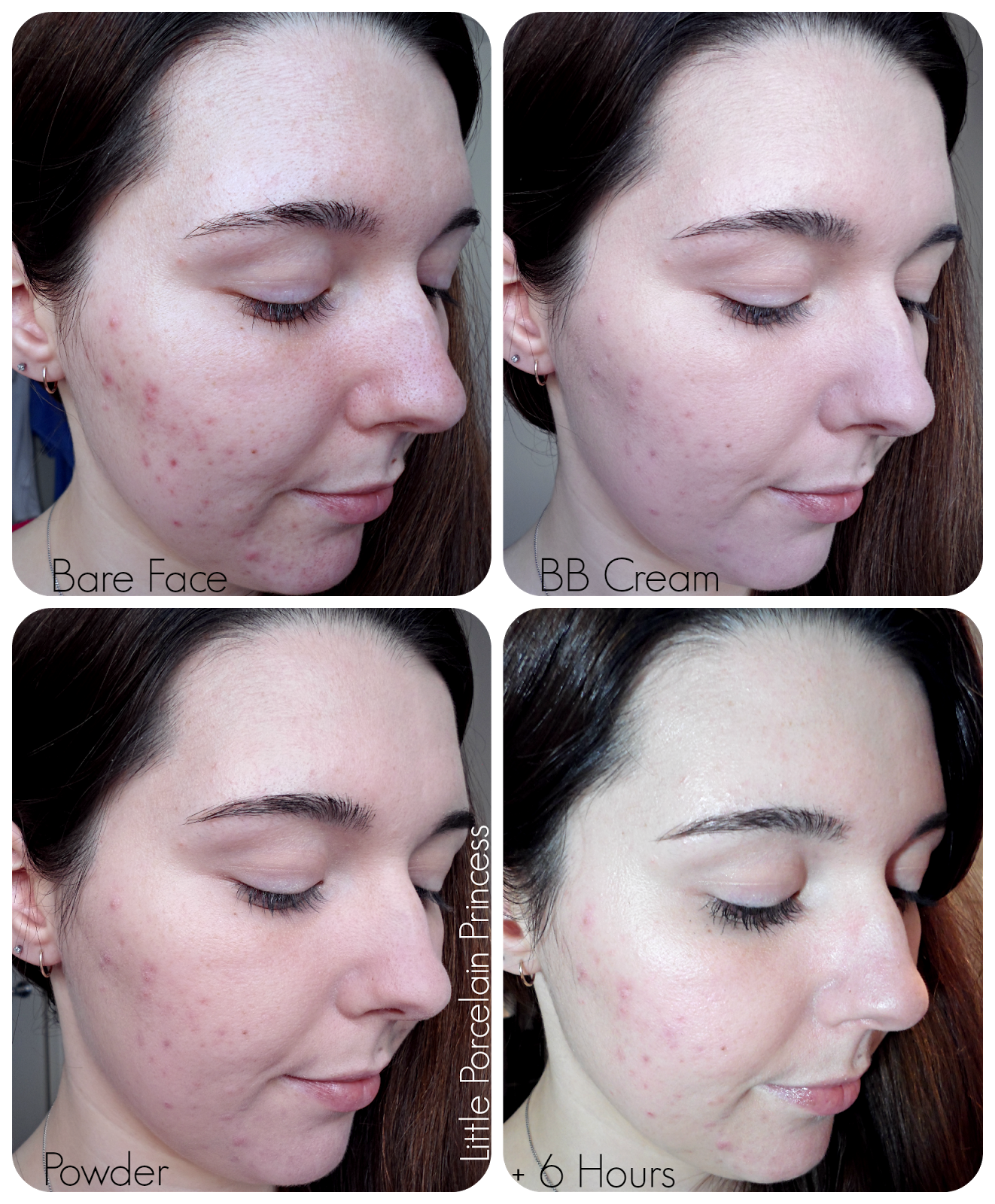 bb cream for acne scars