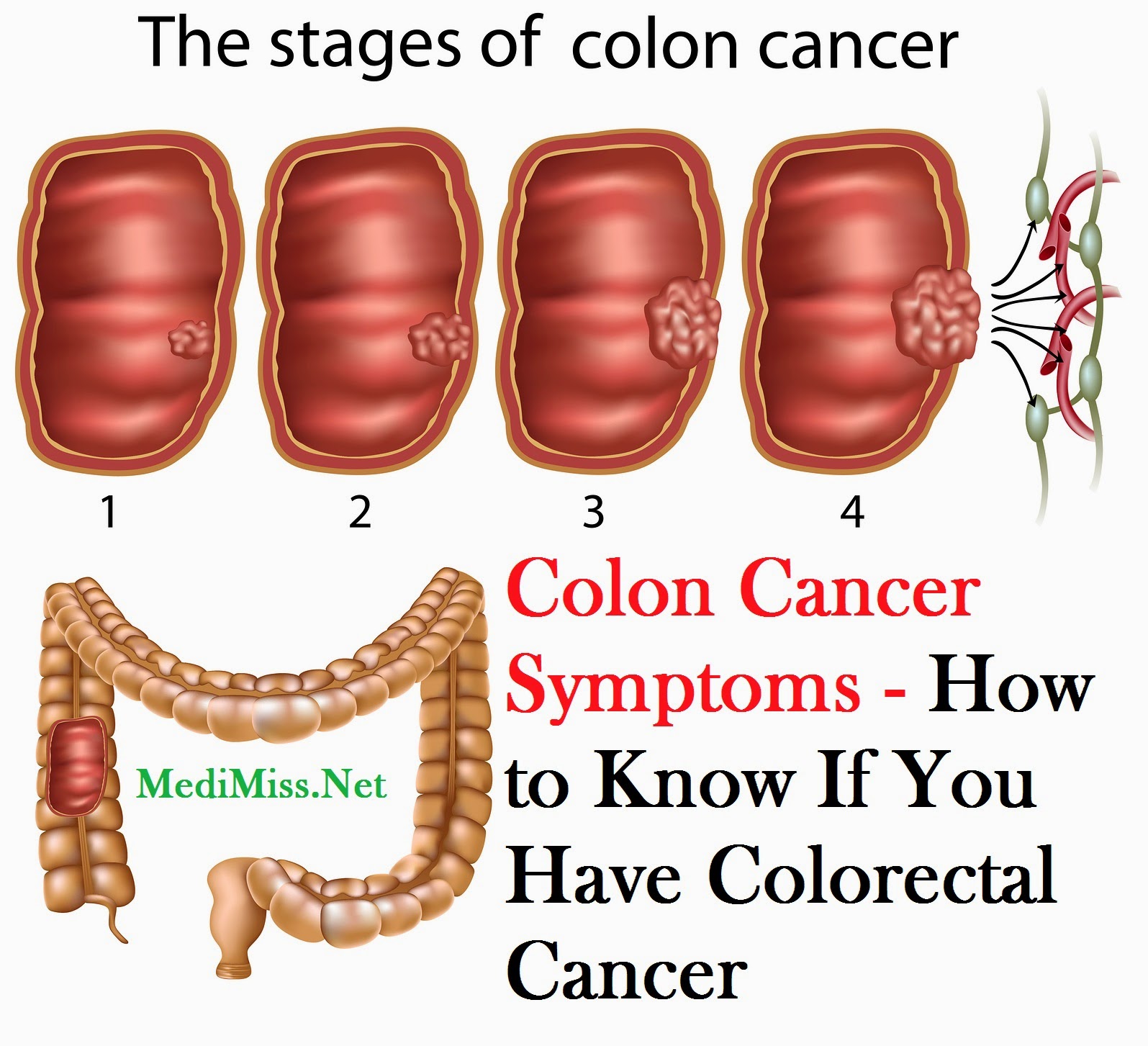 List 90+ Pictures Pictures Of Cancerous Colon Polyps Updated