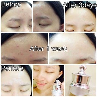 Image result for perliere upgraded