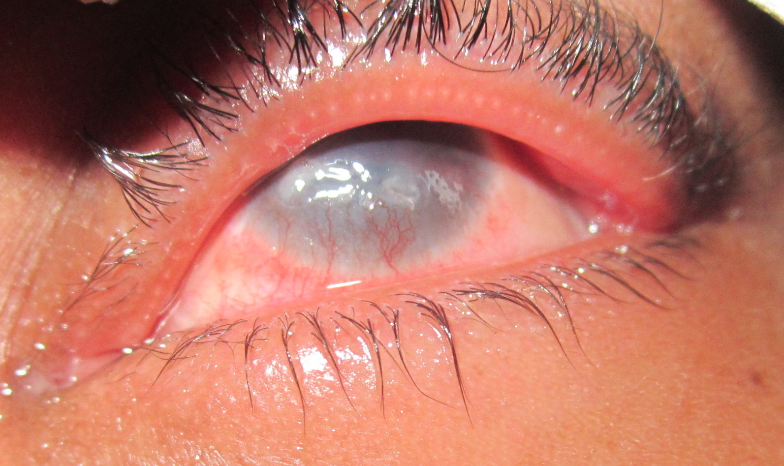 So Richly Blessed First Angolan Cornea Transplant