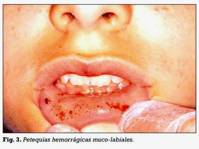 PDF: LEUCEMIA - Complicaciones Orales en edad pediátrica