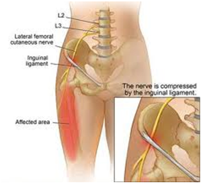 meralgia paresthetica exercises