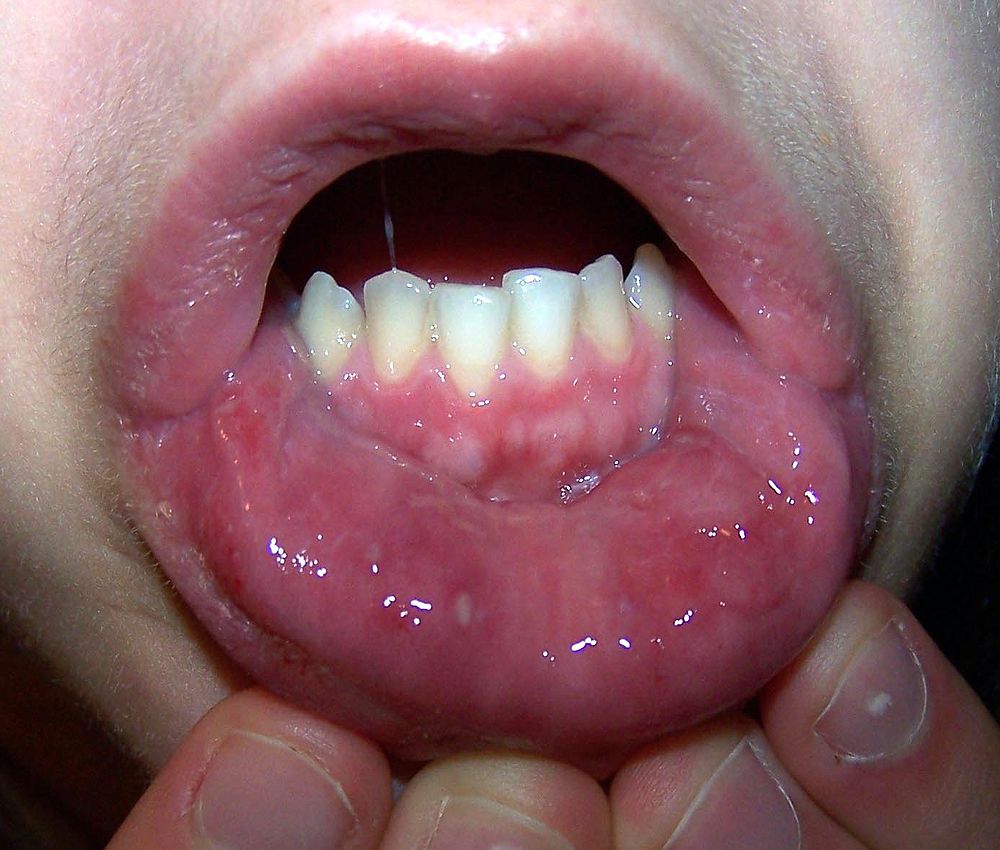 Mucosal Mouth 118