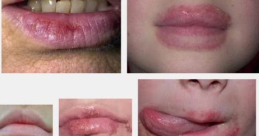 Ubat Kulit Gatal : Krim Ubat Gatal Kulit Zaricort yang biasa saya guna