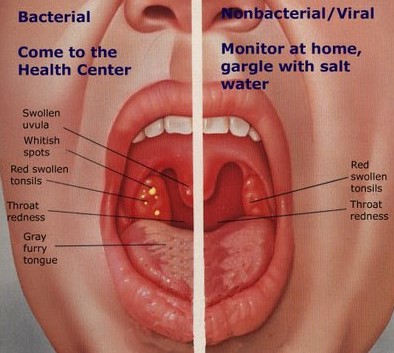 White Spots On Throat Common Causes Images Included HEALTH LIFESTYLE