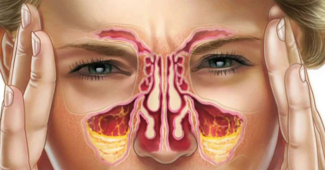 nasal drip nasal drip