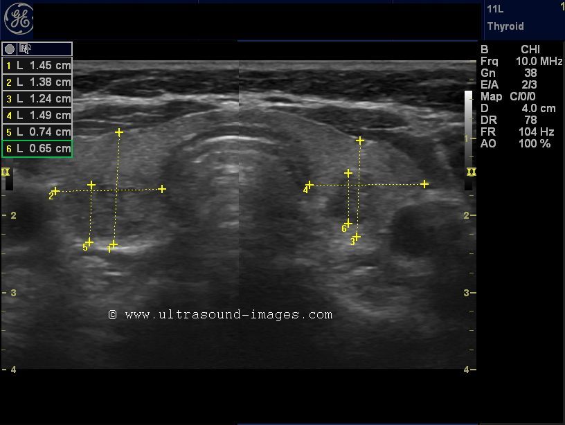 Ultrasound imaging Elastography of thyroid nodules