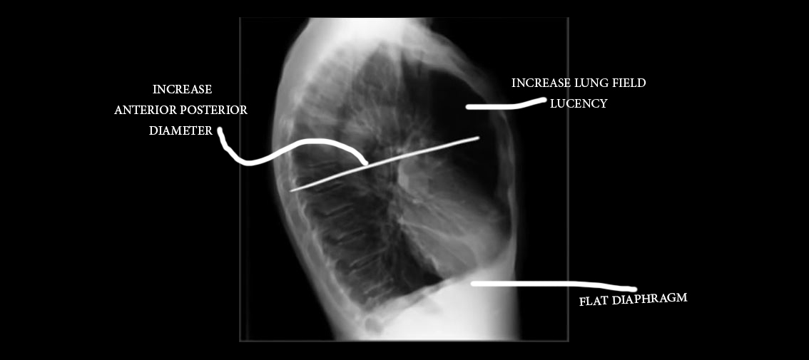 Emphysema Chest X Ray