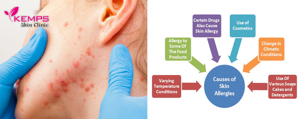 What Is The Root Cause Of Skin Allergies Kemps Skin Clinic