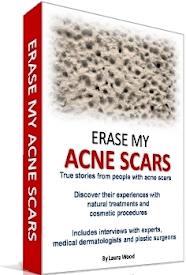 Erase My Acne Scars