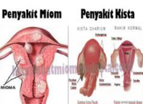 Terna Herba Ini Diyakini Ampuh Usir Mioma Terna Herba Ini Diyakini Ampuh Usir Mioma