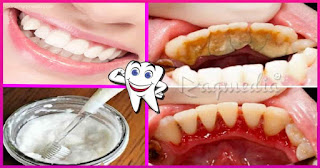 tooth-decay-home-remedy وصفة-مجربة-لازالة-الجير-وتبييض-الاسنان