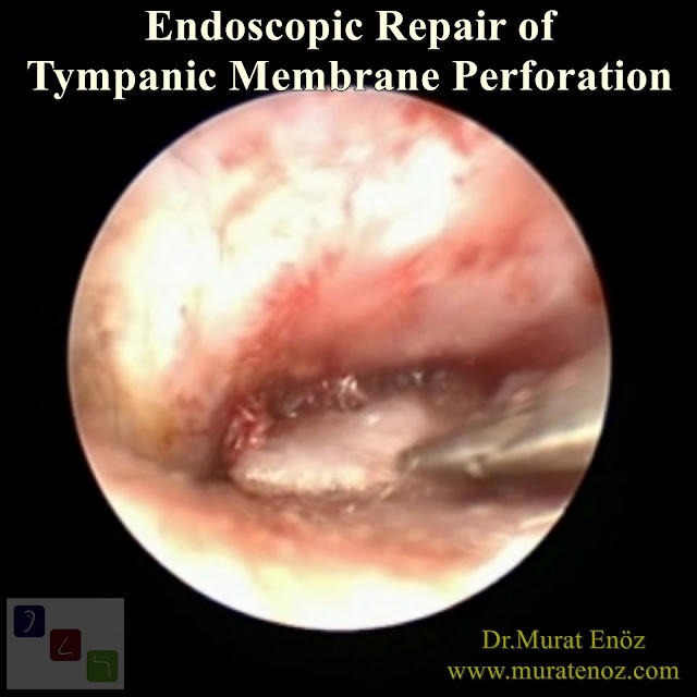 Endoscopic Eardrum Repair - Endoscopic Repair of Tympanic Membrane Perforation - Transcanal Endoscopic Myringoplasty - Endoscope Assisted Myringoplasty - Endoscopic Myringoplasty - Endoscopic-Assisted Myringoplasty - Endoscopic Eardrum Hole Surgery