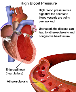 hypertension-artérielle-cholestérol-triglycérides-remèdes 
