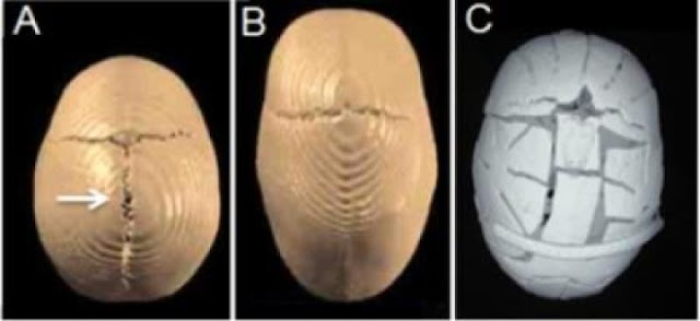 метопический шов костей черепа. сагиттальный шов черепа новорожденного. синдром крузона крузона. срастание костей черепа. сагиттальный краниостеноз.