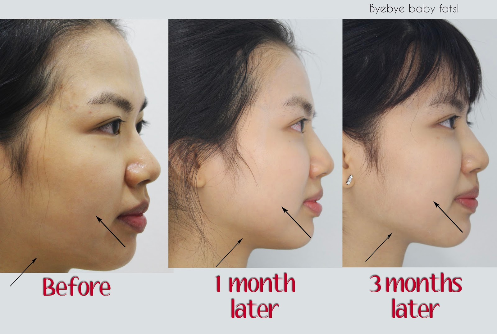 [Review]004 HIFU at Lux Medical Aesthetic Clinic Changing my face shape? Dancing in the skies ♥