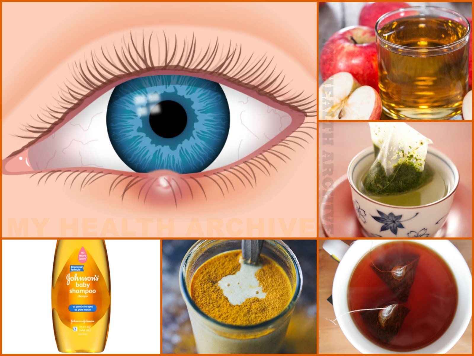 How To Treat A Stye Naturally How To Treat A Stye Naturally