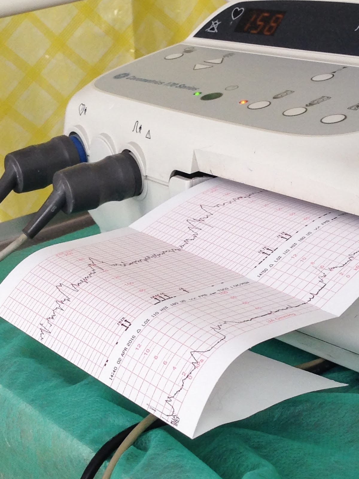 Niesforna Zuzia Zapis KTG co to takiego i po co się go robi?