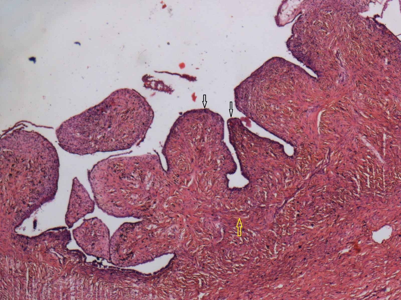 Journal of Postgraduate Gynecology & Obstetrics Cystadenofibroma Of Ovary