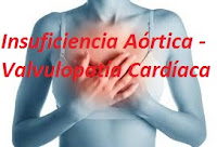 Insuficiencia Aórtica - Valvulopatía Cardíaca
