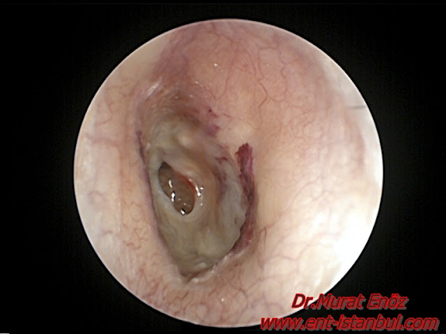 Ruptured eardrum - Traumatic ear drum perforation - Treatment of perforated eardrum - Eardrum repair Istanbul - Eardrum repair Turkey - Eardrum surgery in Istanbul - Eardrum hole operation in Turkey