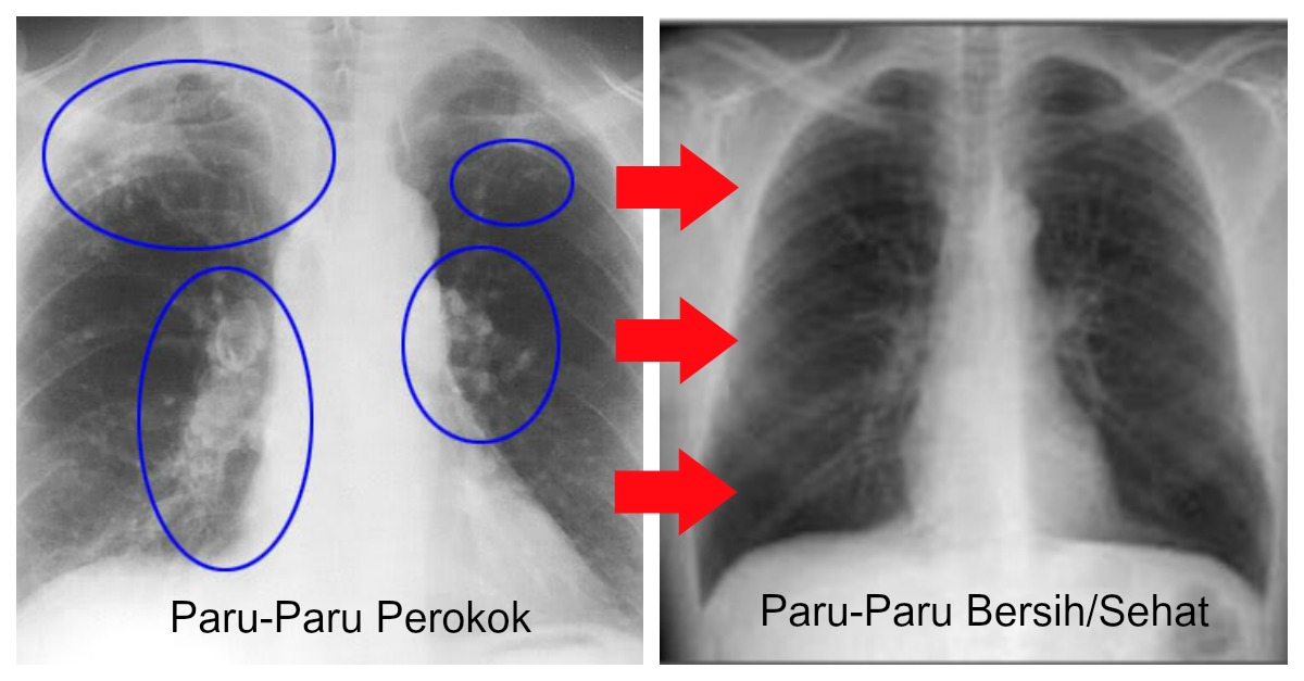 Paru - Paru Perokok Bisa Bersih Lagi Hanya Dengan Rajin Konsumsi 9