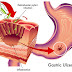 STOMACH CANCER IS A SILENT KILLER! HERE ARE THE SIGNS & SYMPTOMS