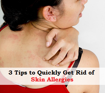 3 Tips to Quickly Get Rid of Skin Allergies 3 Tips to Quickly Get Rid of Skin Allergies