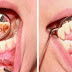 Como eliminar el sarro de tus dientes en 5 minutos sin gastar dinero en dentistas