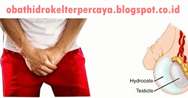 Obat Hidrokel Paling Aman Dan Terpercaya Obat Hidrokel Paling Aman Dan Terpercaya