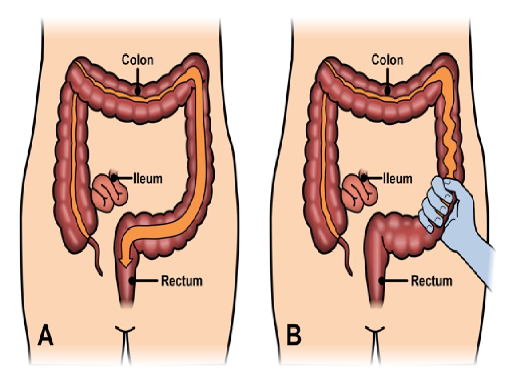 Menú para colon irritable