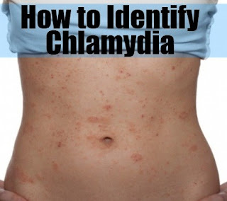Chlamydia Chlamydia