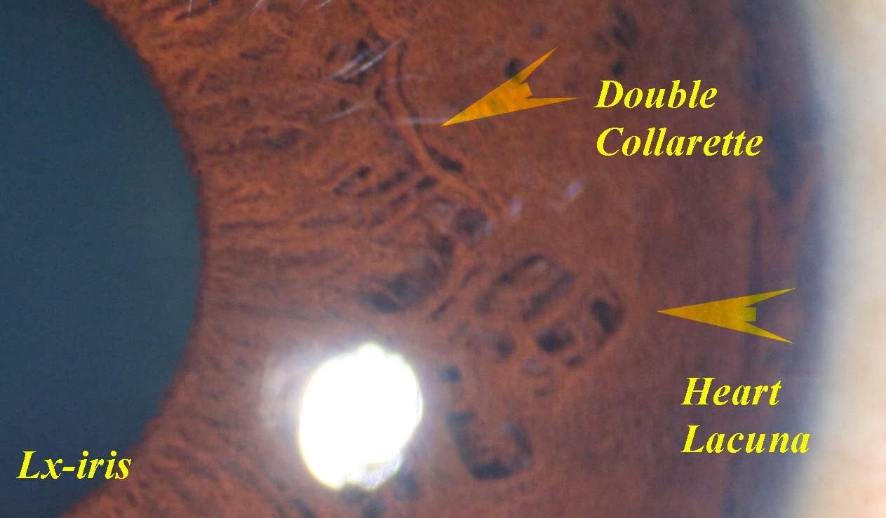 Modern & Multidimensional Iridology IPB, Pupillary Zone, Collarette