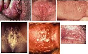 Ciri Ciri Terkena Sipilis Pada Pria dan Wanita Kumpulan Foto Sipilis Pada Pria dan Wanita Mengenali Tahap-Tahap dan Tanda Tanda Sipilis Obat Raja Singa di Apotik Cara Alami Menyembuhkan Penyakit Sipilis Nama Obat Gonore di Apotik Yang Ampuh dan Paten Berapa Lama Penyembuhan Sipilis Sampai Tuntas Cara Mengobati Penyakit Sipilis Pada Wanita Cara Menyembuhkan Sipilis Dengan Propolis Tanda Penyakit Sifilis pada Wanita yg Wajib Anda Ketahui Bagaimana cara mengobati sipilis yang paling cepat Berapa Lama Penyembuhan Sipilis Sampai Tuntas Terasa Terbakar Dan Nyeri pada Penis Penyakit Apa Lesi Di kepala Penis Lecet Panas Dan Perih Lecet-Lacet Luka Perih Pada Penis Pria Lecet-Lacet Luka Perih Pada Vagina Wanita Obat Penis Perih Dan Panas Saat Kencing Penyebab Luka Lecet dan Gatal Pada Vagina Ciri Ciri Terkena Sipilis Pada Pria dan Wanita Kumpulan Foto Sipilis Pada Pria dan Wanita Mengenali Tahap-Tahap dan Tanda Tanda Sipilis Obat Raja Singa di Apotik Cara Alami Menyembuhkan Penyakit Sipilis Nama Obat Gonore di Apotik Yang Ampuh dan Paten Berapa Lama Penyembuhan Sipilis Sampai Tuntas Cara Mengobati Penyakit Sipilis Pada Wanita Cara Menyembuhkan Sipilis Dengan Propolis Tanda Penyakit Sifilis pada Wanita yg Wajib Anda Ketahui Bagaimana cara mengobati sipilis yang paling cepat Berapa Lama Penyembuhan Sipilis Sampai Tuntas Terasa Terbakar Dan Nyeri pada Penis Penyakit Apa Lesi Di kepala Penis Lecet Panas Dan Perih Lecet-Lacet Luka Perih Pada Penis Pria Lecet-Lacet Luka Perih Pada Vagina Wanita Obat Penis Perih Dan Panas Saat Kencing Penyebab Luka Lecet dan Gatal Pada Vagina Ciri Ciri Terkena Sipilis Pada Pria dan Wanita Kumpulan Foto Sipilis Pada Pria dan Wanita Mengenali Tahap-Tahap dan Tanda Tanda Sipilis Obat Raja Singa di Apotik Cara Alami Menyembuhkan Penyakit Sipilis Nama Obat Gonore di Apotik Yang Ampuh dan Paten Berapa Lama Penyembuhan Sipilis Sampai Tuntas Cara Mengobati Penyakit Sipilis Pada Wanita Cara Menyembuhkan Sipilis Dengan Propolis Tanda Penyakit Sifilis pada Wanita yg Wajib Anda Ketahui Bagaimana cara mengobati sipilis yang paling cepat Berapa Lama Penyembuhan Sipilis Sampai Tuntas Terasa Terbakar Dan Nyeri pada Penis Penyakit Apa Lesi Di kepala Penis Lecet Panas Dan Perih Lecet-Lacet Luka Perih Pada Penis Pria Lecet-Lacet Luka Perih Pada Vagina Wanita Obat Penis Perih Dan Panas Saat Kencing Penyebab Luka Lecet dan Gatal Pada Vagina