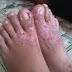 Cara Mengobati Gatal Pada kulit Kaki karena Jamur Kulit