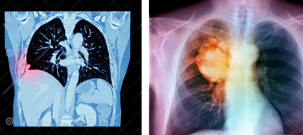cosa aspettarsi dopo le radiazioni per il cancro alla prostata