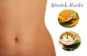 See How to Remove Stretch Marks - Fastest Way
