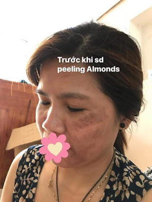 Peel da Almonds Biological Skin Peeling 29 38284412 2187901878111908 2711718462362746880 n