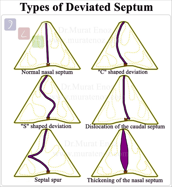 Nazal Septum Deviasyonu Çeşitleri - Nazal Septum Deviasyonu Türleri