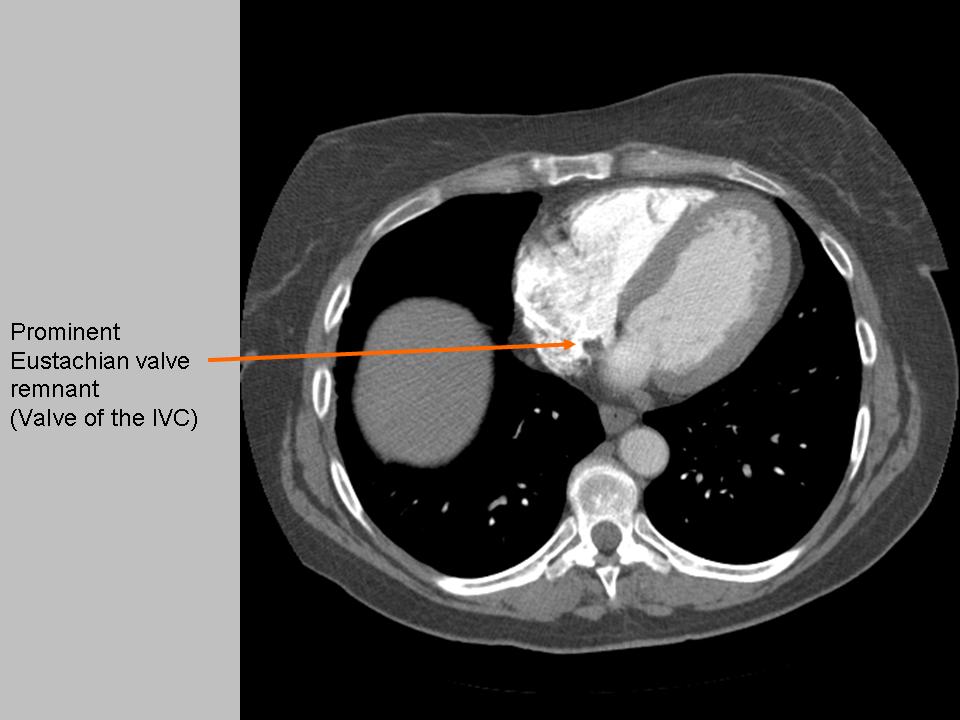 The Pump and the Tubes Eustachian Valve