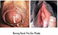 Obat Kencing Keluar Nanah Di Apotik Paling Ampuh Obat Kencing Keluar Nanah Di Apotik Paling Ampuh