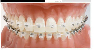 Niềng răng mắc cài tự đóng có hiệu quả gì?
