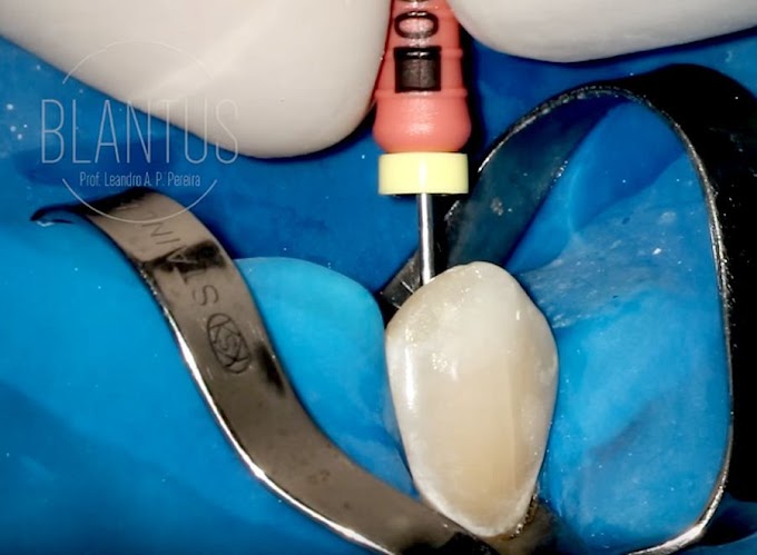 CLINICAL CASE: Full Piezo Endodontic Treatment