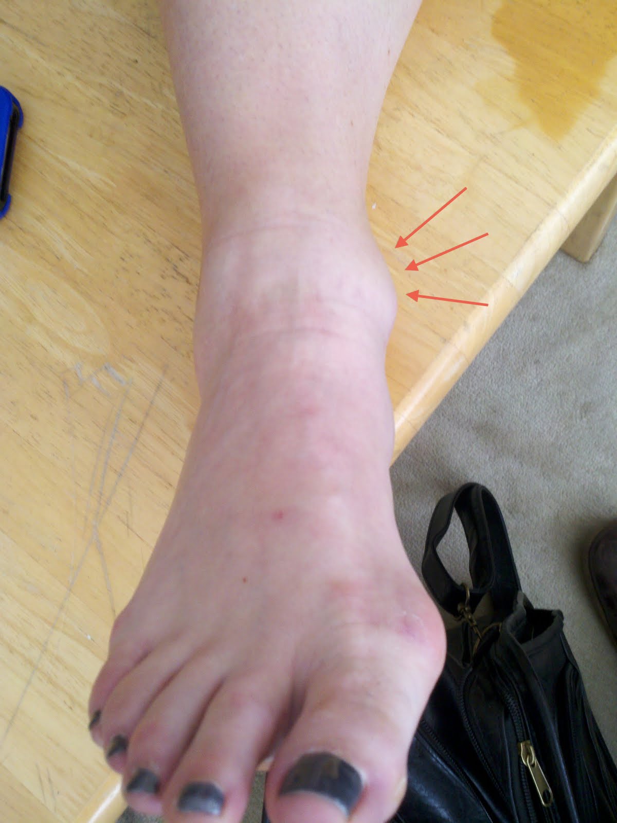 My Running Doc: When is Surgery Needed for a Ganglion Cyst in the Foot ...