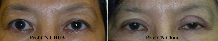 Eyelid Surgery by Prof Dr CN CHUA 蔡鐘能: Unequal Double Eyelids (skin ...
