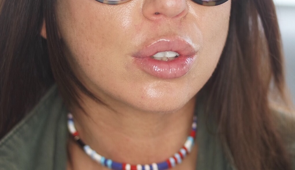 how-to-deal-with-deep-painful-cystic-acne-leo-with-cancer