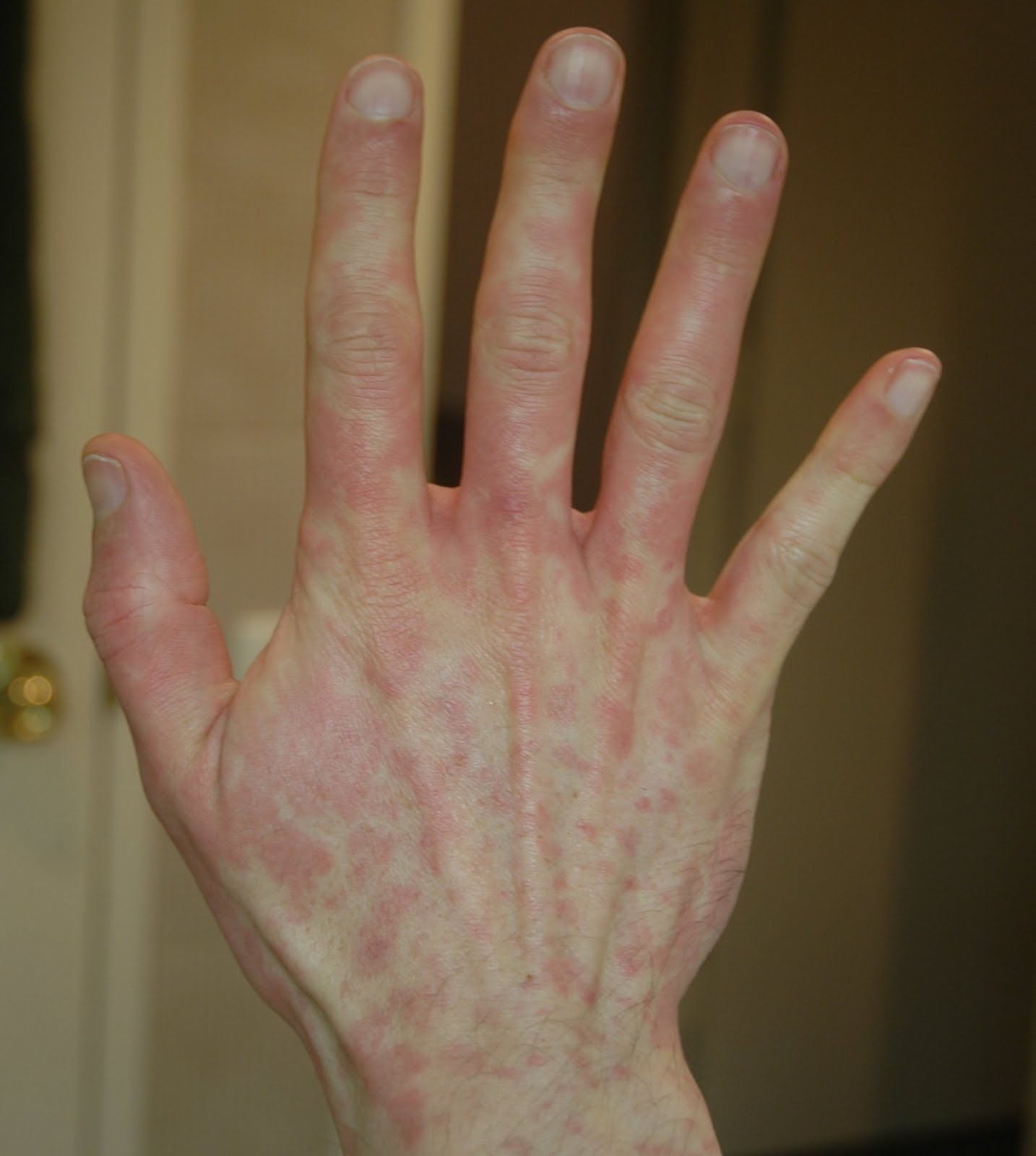 The top of my hands get an itchy rash, but only there ...