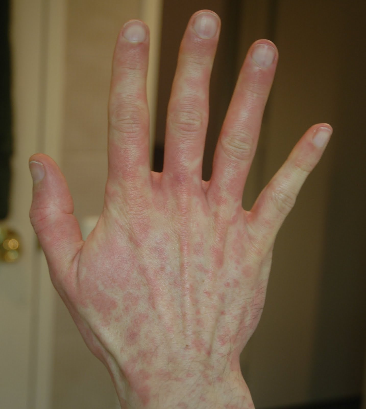 Winter Rash On Hands Hand Rashes Albuquerque NM Dermatologist 